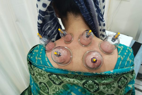 Dry cupping